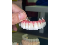 深圳种植牙义齿加工厂家出口图2
